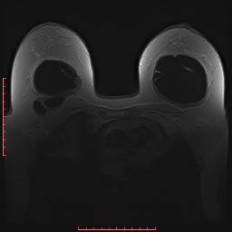 File:Bilateral breast implant rupture (Radiopaedia 24761-25027 PASTA 10).jpg