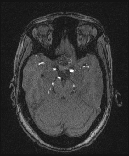 Bilateral carotid body tumors and right glomus jugulare tumor (Radiopaedia 20024-20060 Axial MRA 67).jpg