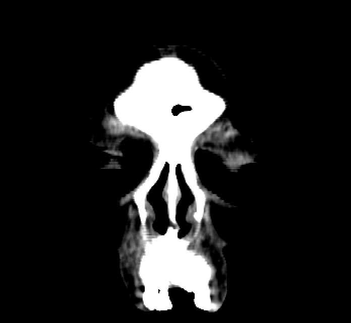Bilateral ectopia lentis (Radiopaedia 89889-107013 Coronal non-contrast 2).jpg