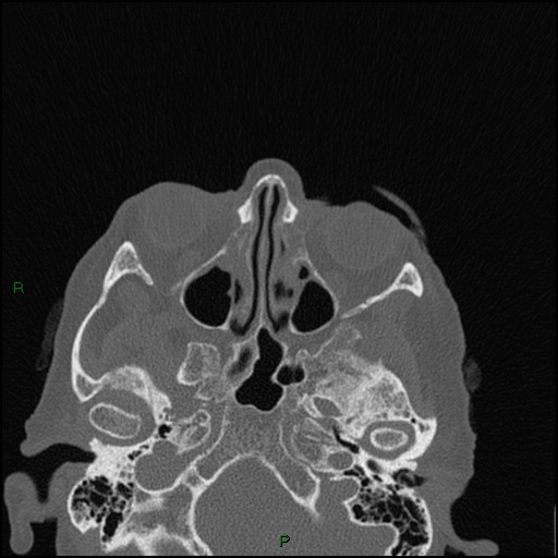 Bilateral frontal mucoceles (Radiopaedia 82352-96454 Axial bone window 165).jpg