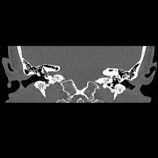 File:Bilateral ossifications of the external auditory canal (Radiopaedia 15233-15076 Coronal bone window 13).jpg