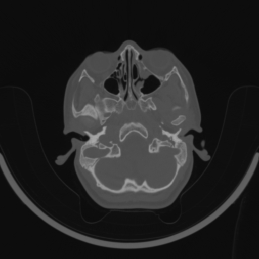 Bilateral otosclerosis (Radiopaedia 57237-64157 C 22).jpg