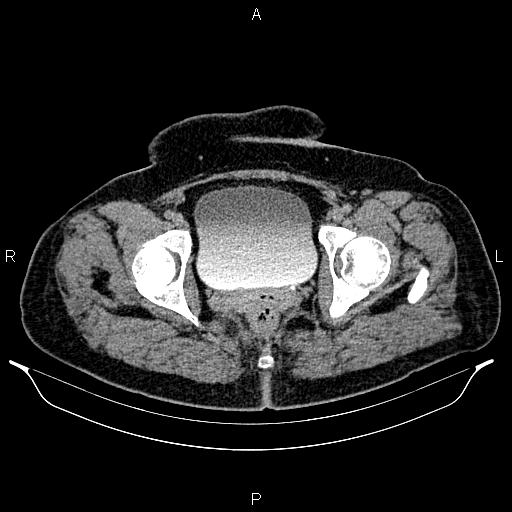 Bilateral ovarian dermoid cysts (Radiopaedia 85785-101603 Axial C+ delayed 82).jpg