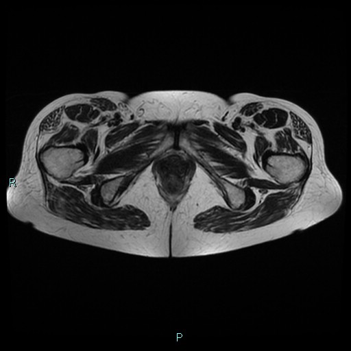 File:Bilateral ovarian fibroma (Radiopaedia 44568-48293 Axial T2 28).jpg
