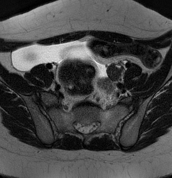 File:Bilateral ovarian fibrothecomas - adolescent (Radiopaedia 86604-102707 Axial T2 12).jpg