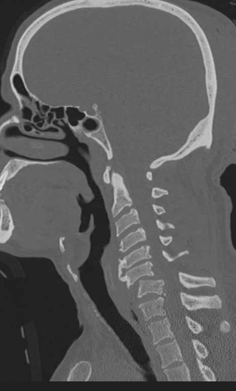 Bilateral perched facet joint (Radiopaedia 63149-71669 Sagittal bone window 33).jpg
