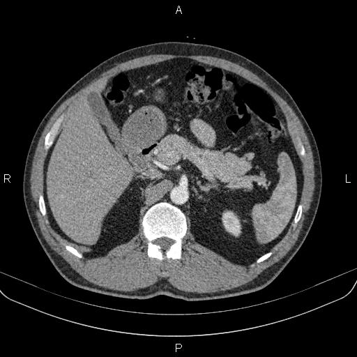 Bilateral pulmonary AVM (Radiopaedia 83134-97505 A 79).jpg