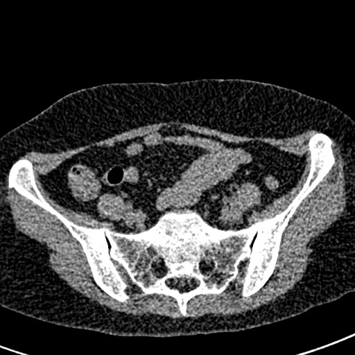 Bilateral staghorn calculi (Radiopaedia 59475-66842 Axial non-contrast 59).jpg
