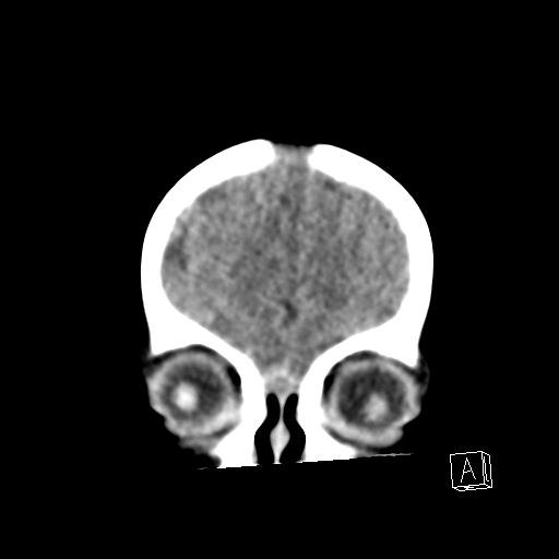 File:Bilateral subdural hemorrhage and parietal skull fracture (Radiopaedia 26058-26192 Coronal non-contrast 3).png