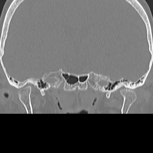 File:Bilateral tympanoplasty (Radiopaedia 16947-16664 Coronal bone window 2).jpg