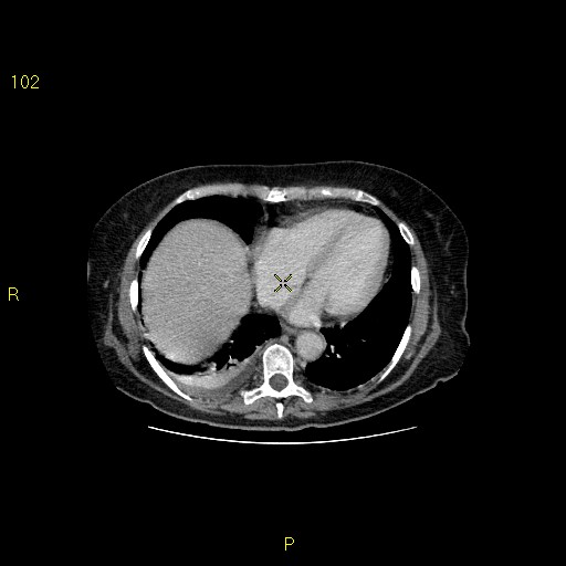 File:Biloma with drainage into the colon (Radiopaedia 20032-20068 A 16).jpg