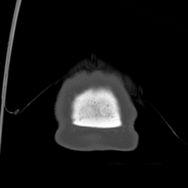 Biparietal osteodystrophy (Radiopaedia 46109-50463 Coronal bone window 106).jpg