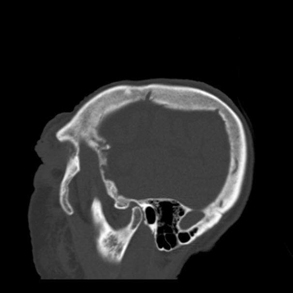 Biparietal osteodystrophy (Radiopaedia 46109-50463 Sagittal bone window 89).jpg