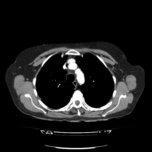File:Bladder tumor detected on trauma CT (Radiopaedia 51809-57609 A 30).jpg