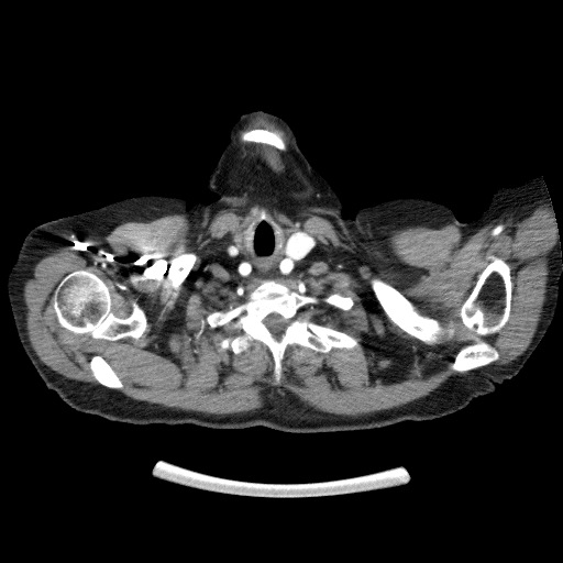 Bladder tumor detected on trauma CT (Radiopaedia 51809-57609 A 9).jpg