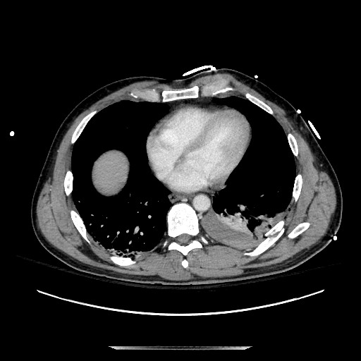 Blunt abdominal trauma with solid organ and musculoskelatal injury with active extravasation (Radiopaedia 68364-77895 A 2).jpg