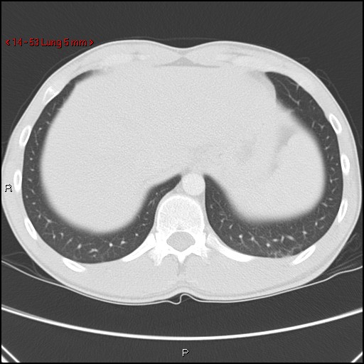 Blunt chest trauma - pulmonary interstitial emphysema and pneumomediastinum (Radiopaedia 20666-20552 Axial lung window 53).jpg