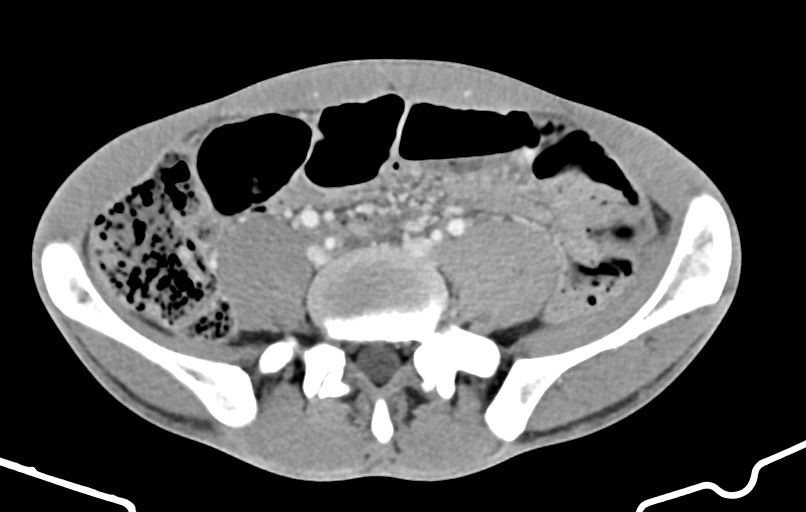 Blunt injury to the small bowel (Radiopaedia 74953-85987 A 128).jpg