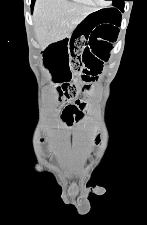 Blunt injury to the small bowel (Radiopaedia 74953-85987 B 20).jpg