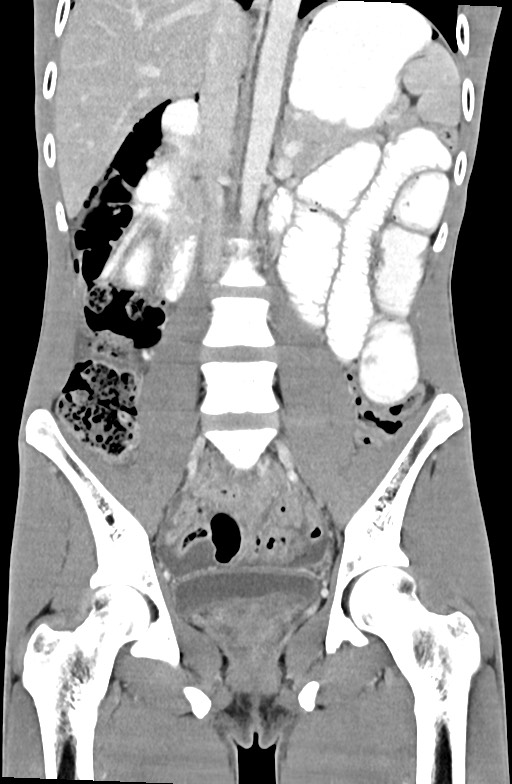 Blunt injury to the small bowel (Radiopaedia 74953-85987 B 53).jpg