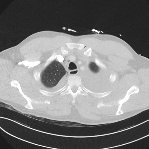 File:Boerhaave syndrome (Radiopaedia 39382-41660 Axial lung window 9).png