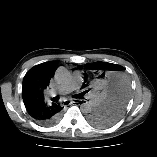 Boerhaave syndrome (Radiopaedia 59796-67310 Axial liver window 30).jpg
