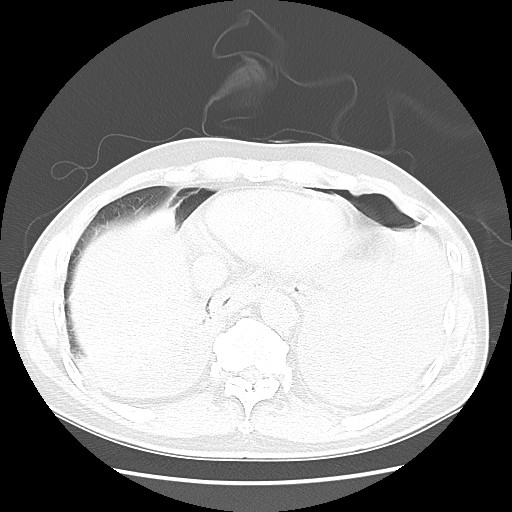 File:Boerhaave syndrome (Radiopaedia 59796-67310 Axial lung window 49).jpg