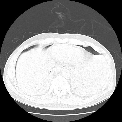 File:Boerhaave syndrome (Radiopaedia 59796-67310 Axial lung window 50).jpg