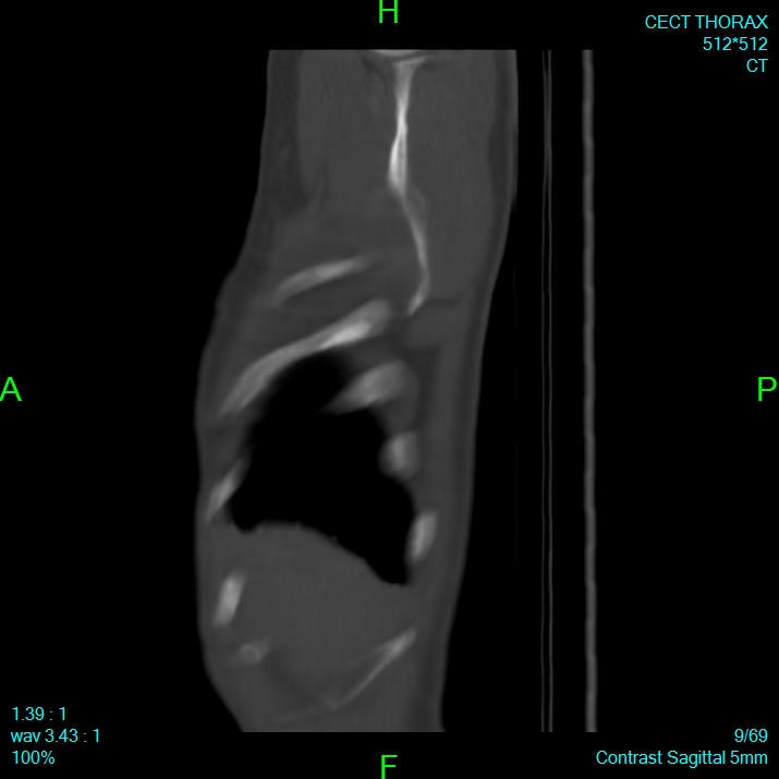 Bone metastases from lung carcinoma (Radiopaedia 54703-60937 Sagittal bone window 9).jpg