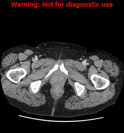 File:Bosniak renal cyst - type II (Radiopaedia 23404-23468 D 77).jpg
