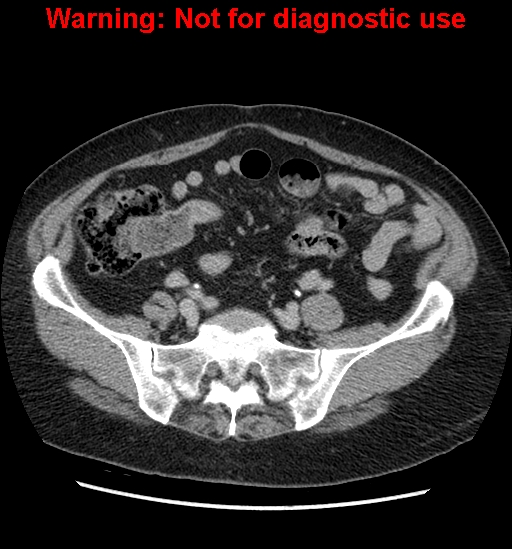 File:Bosniak renal cyst - type II (Radiopaedia 23404-23468 F 46).jpg