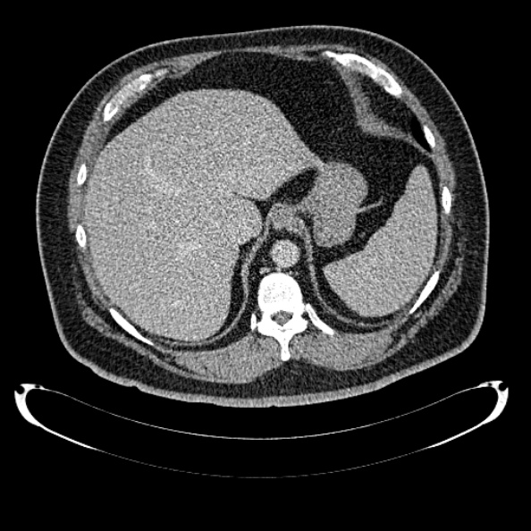 Bosniak renal cyst - type IV (Radiopaedia 24244-24518 C 47).jpg