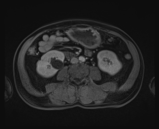 File:Bouveret syndrome (Radiopaedia 61017-68856 Axial T1 C+ fat sat 55).jpg