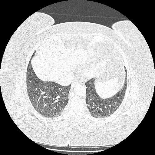 Bovine aortic arch - right internal mammary vein drains into the superior vena cava (Radiopaedia 63296-71875 Axial lung window 121).jpg