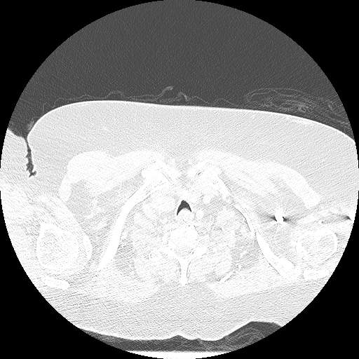 Bovine aortic arch - right internal mammary vein drains into the superior vena cava (Radiopaedia 63296-71875 Axial lung window 5).jpg