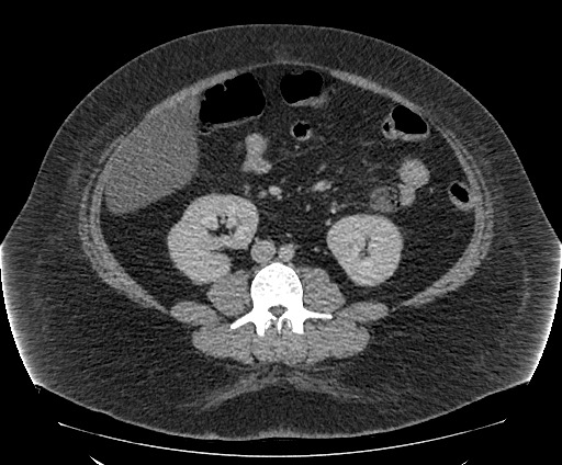 Bowel and splenic infarcts in acute lymphocytic leukemia (Radiopaedia 61055-68913 A 71).jpg