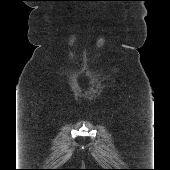 Bowel and splenic infarcts in acute lymphocytic leukemia (Radiopaedia 61055-68913 B 54).jpg