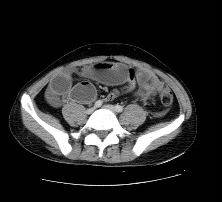 Bowel obstruction from colon carcinoma (Radiopaedia 22995-23028 A 58).jpg