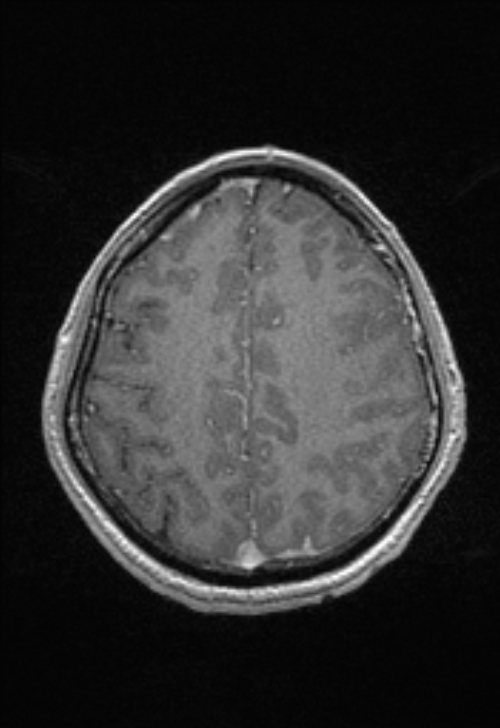 Brain abscess with ventriculitis (Radiopaedia 85703-101495 Axial T1 C+ 130).jpg