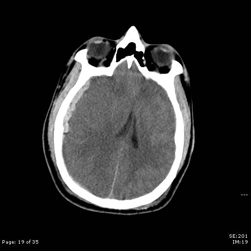 File:Brain death after motor vehicle collision (Radiopaedia 88470-105114 Axial non-contrast 19).jpg