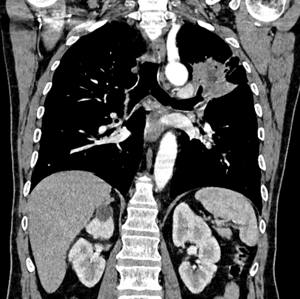 Brain metastases - lung cancer primary (Radiopaedia 75060-86116 C+ arterial phase 41).jpg