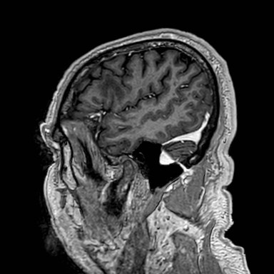 Brain metastases from lung cancer (Radiopaedia 83839-99028 Sagittal T1 C+ 9).jpg