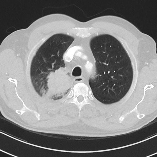 Brain metastasis (large cystic mass) (Radiopaedia 47497-52104 Axial lung window 10).png