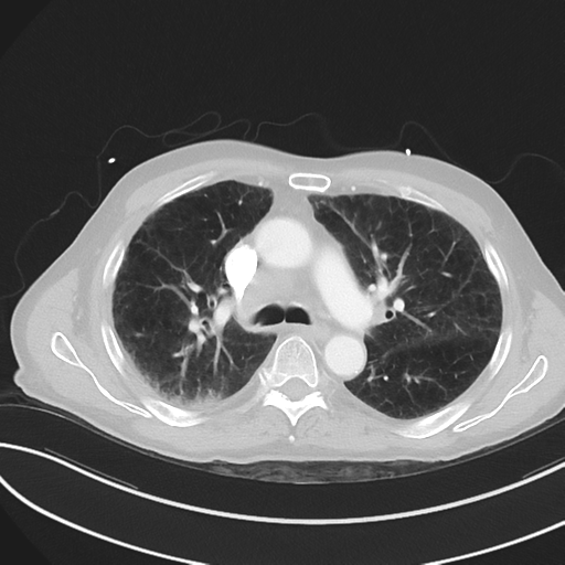 File:Brain metastasis (lung cancer) (Radiopaedia 48289-53180 Axial lung window 25).png