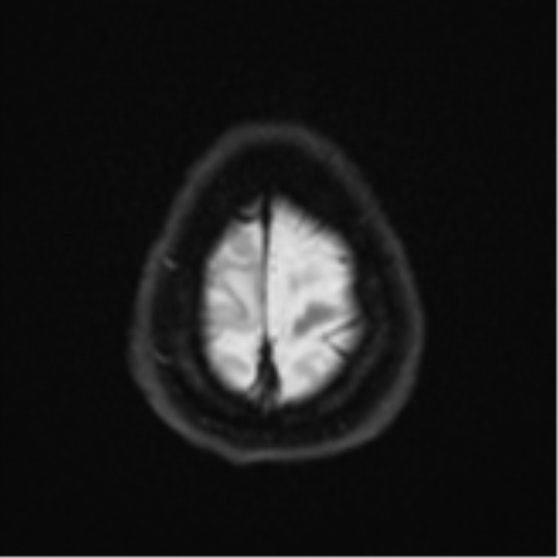 Brain metastasis (sarcoma) (Radiopaedia 47576-52209 Axial DWI 25).png