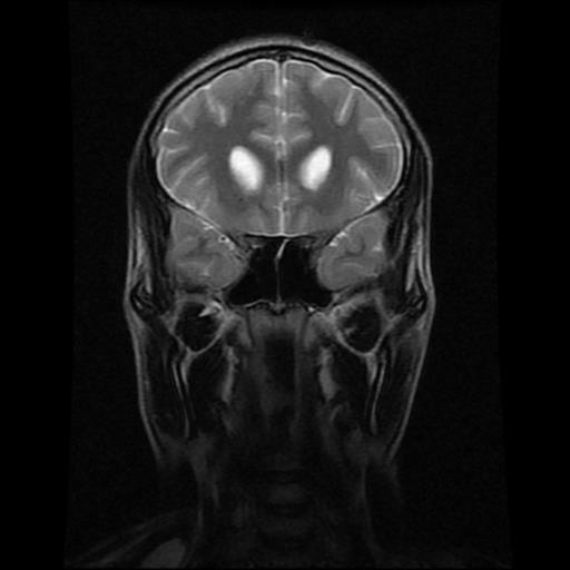 File:Brainstem glioma (Radiopaedia 30923-31624 Coronal T2 14).jpg