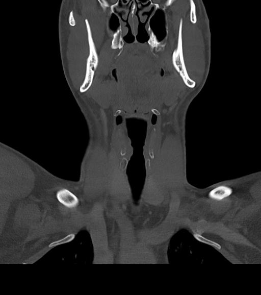 Branchial cleft cyst (Radiopaedia 31167-31875 Coronal bone window 27).jpg
