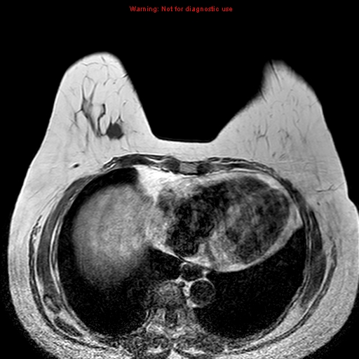 File:Breast carcinoma (multicentric multifocal in mammary Paget disease) (Radiopaedia 50966-56512 Axial T1 1).jpg