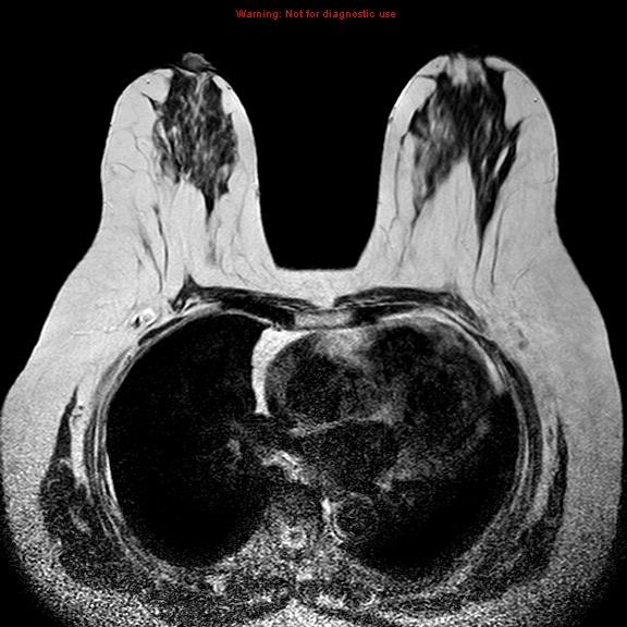 File:Breast carcinoma (multicentric multifocal in mammary Paget disease) (Radiopaedia 50966-56512 Axial T2 9).jpg