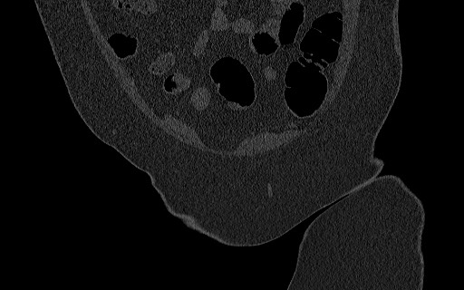 File:Breast carcinoma with pathological hip fracture (Radiopaedia 60314-67993 Coronal bone window 36).jpg